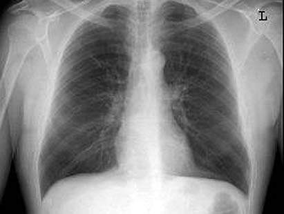 Tüdőszűrés 2015